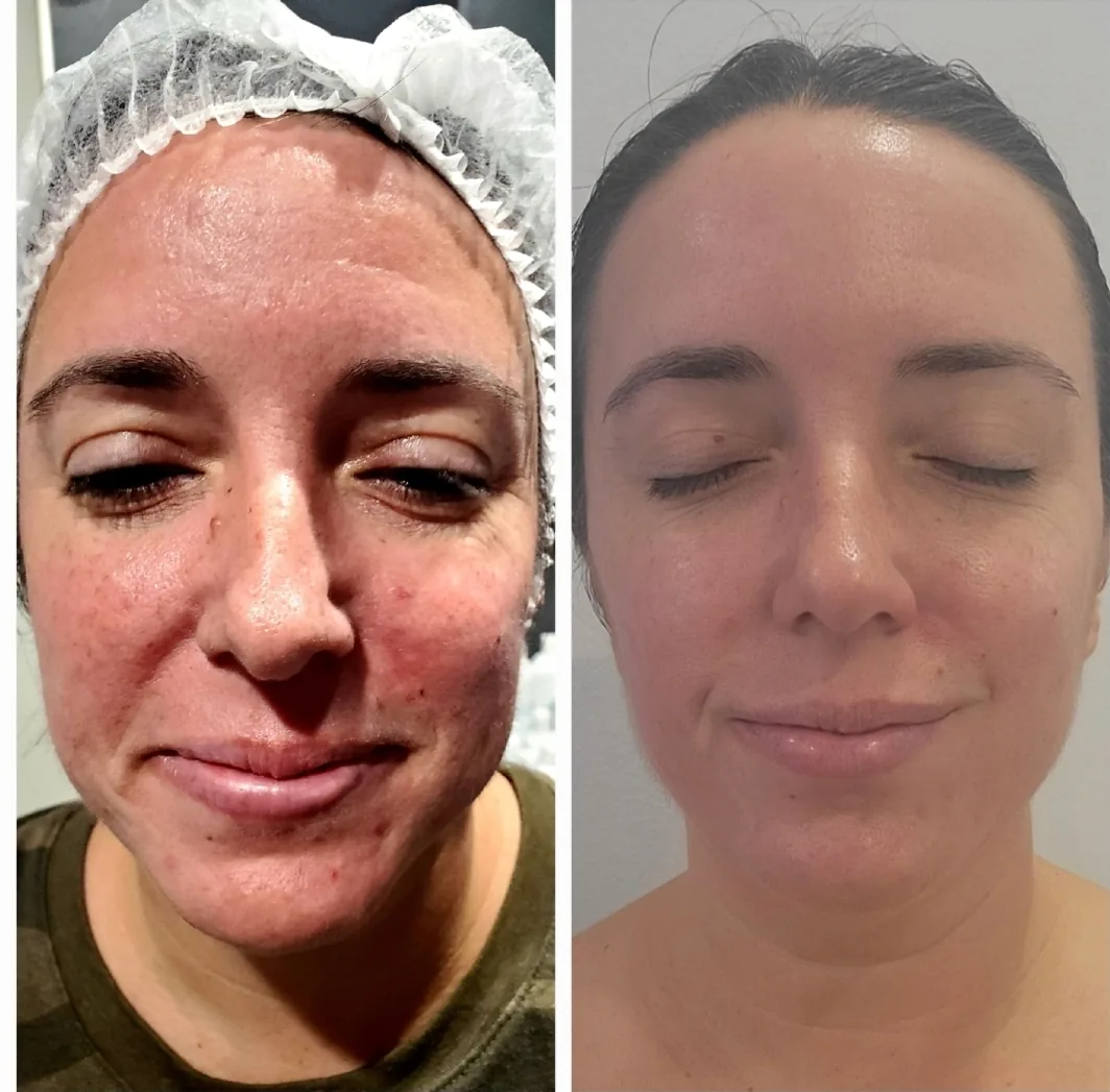 Client before and after the 12-week Acne Treatment Program — dramatic clearing of persistent acne